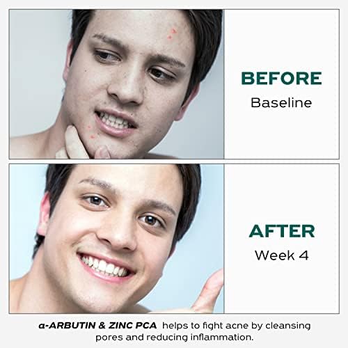 Toner de controle de óleo Mantisfy com benefícios de combate a acne e hidratação, toner para rosto com alfa-arbutina,
