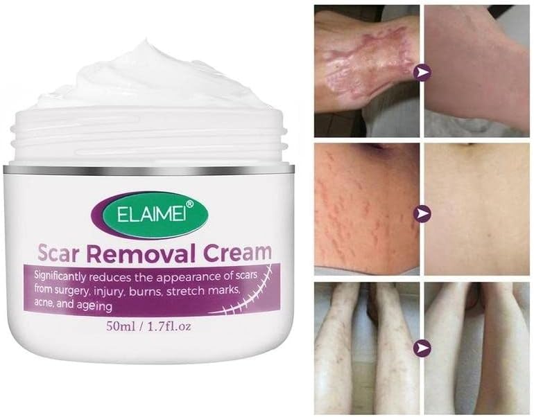 50 ml de remoção de cicatriz Creme de relevo estrias queimaduras Reparar marcas de acne cicatrizes